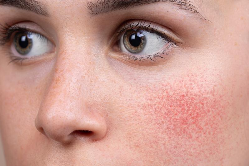 Recognizing the Different Stages of Rosacea Symptoms